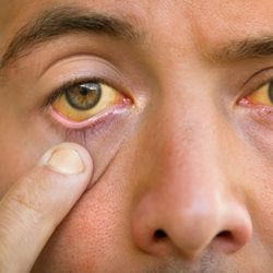 Hepatitida A v Praze - okamžité očkování kontaktů