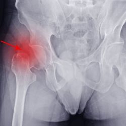 Stodská nemocnice otevírá novou ambulanci. Pomůže odhalit tichého zloděje kostí